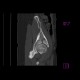 Fracture of pelvis - iliac bone and acetabulum: CT - Computed tomography